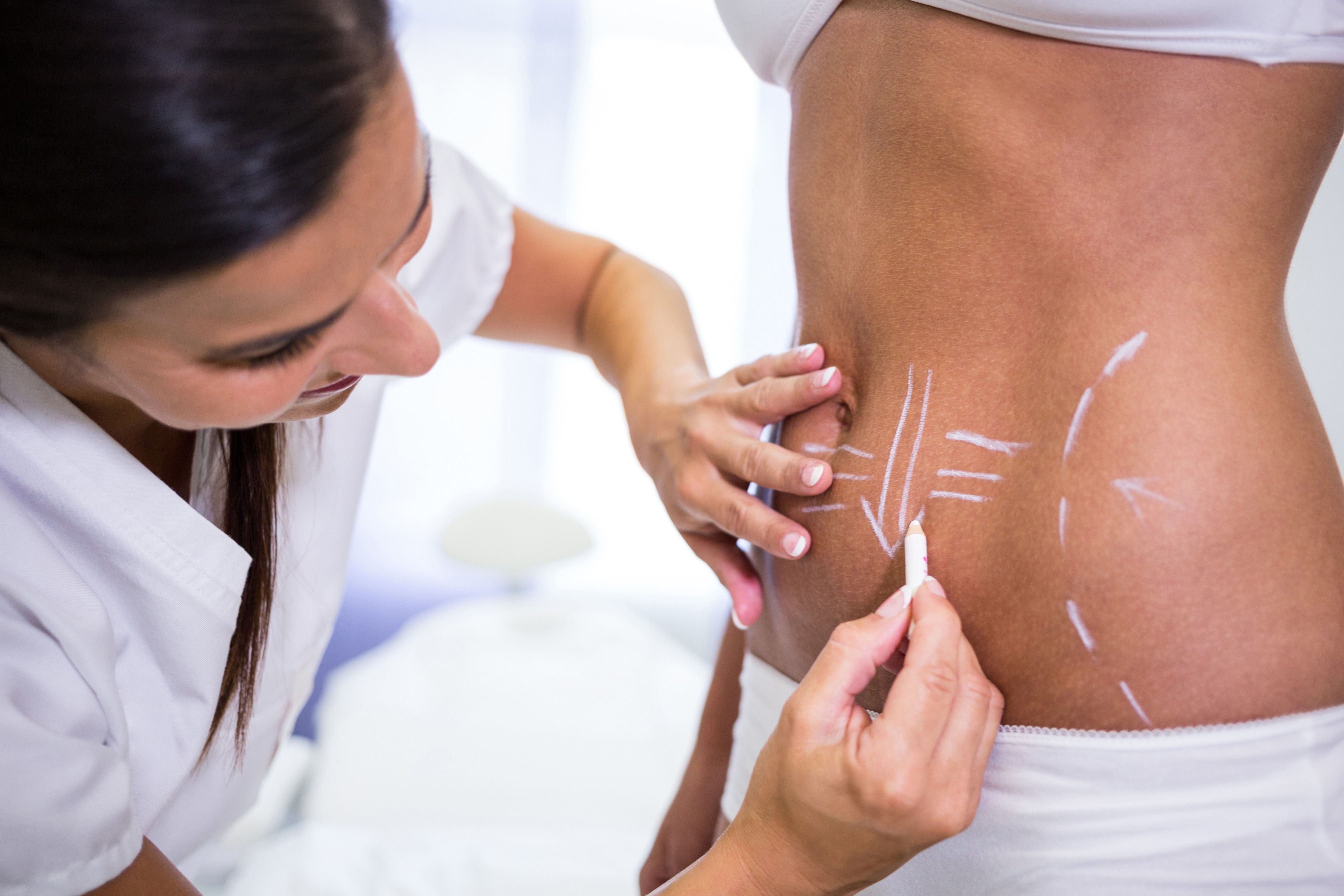 Plastic surgeon marking abdomen before liposuction at Gaelan Hospital Sharjah