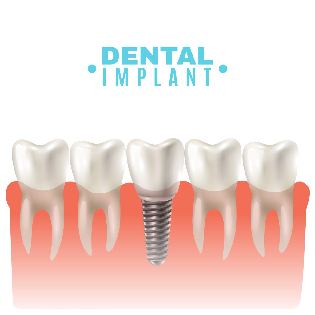 Dental Implants in Sharjah | Gaelan Hospital Sharjah