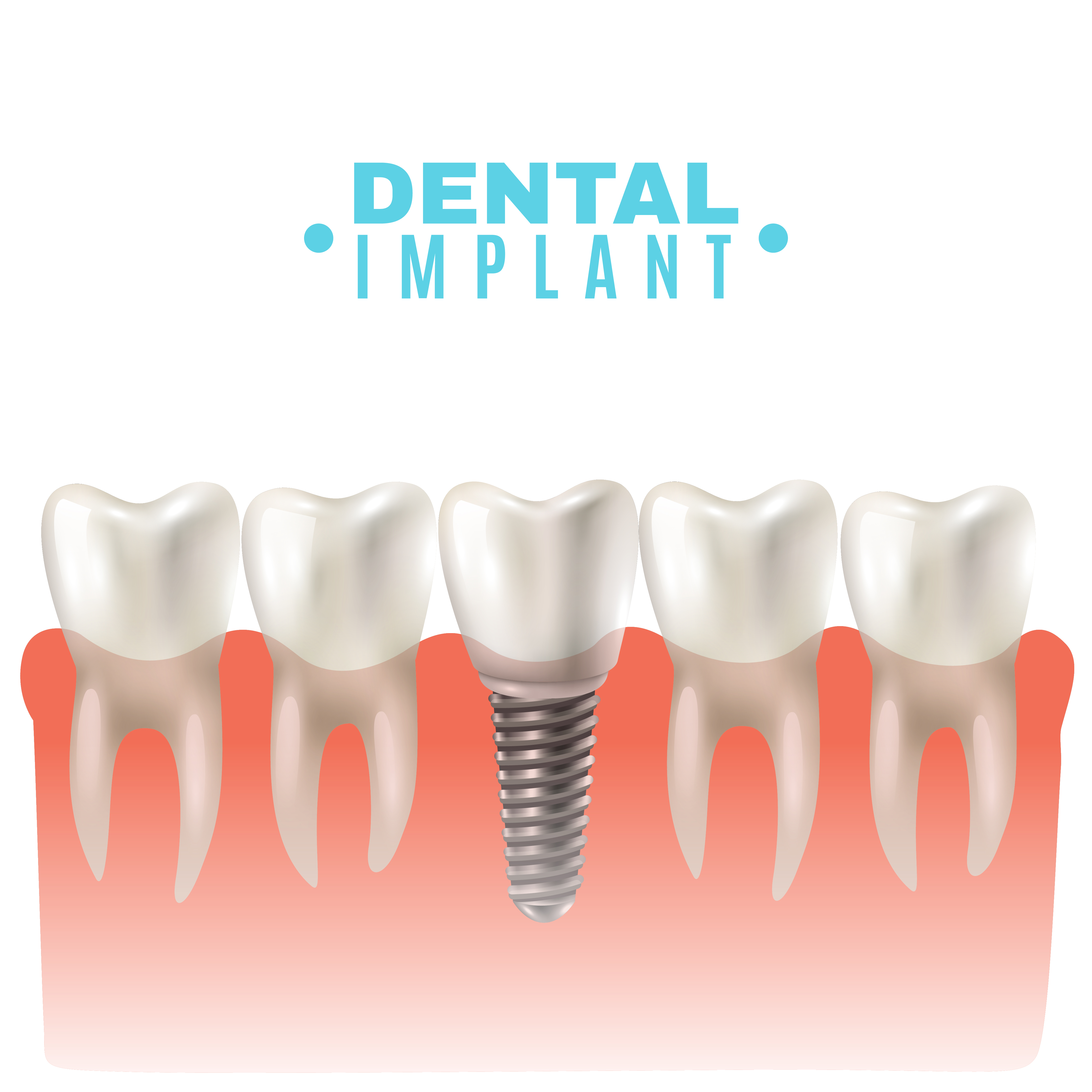 Dental Implants in Sharjah | Gaelan Hospital Sharjah