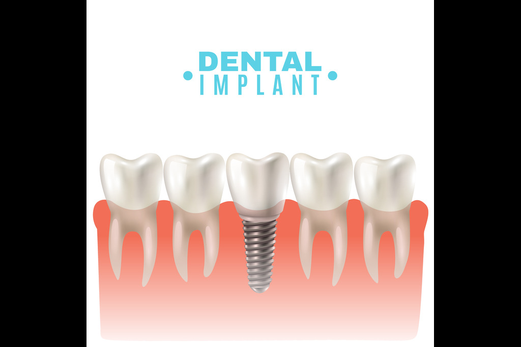 Dental Implants in Sharjah
