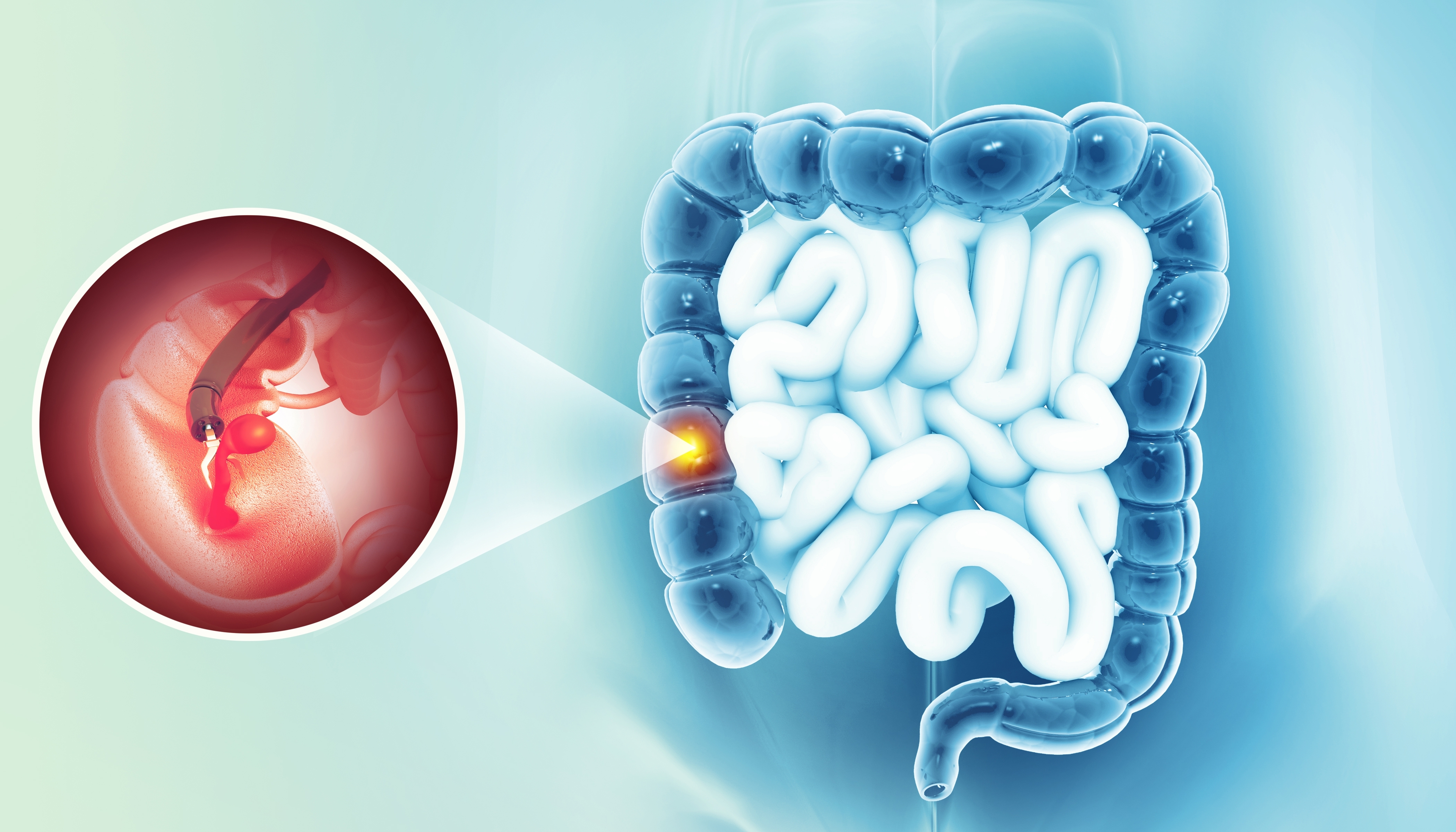 Colonoscopy procedure showing endoscopic removal of colon polyp in Sharjah one-day surgery clinic