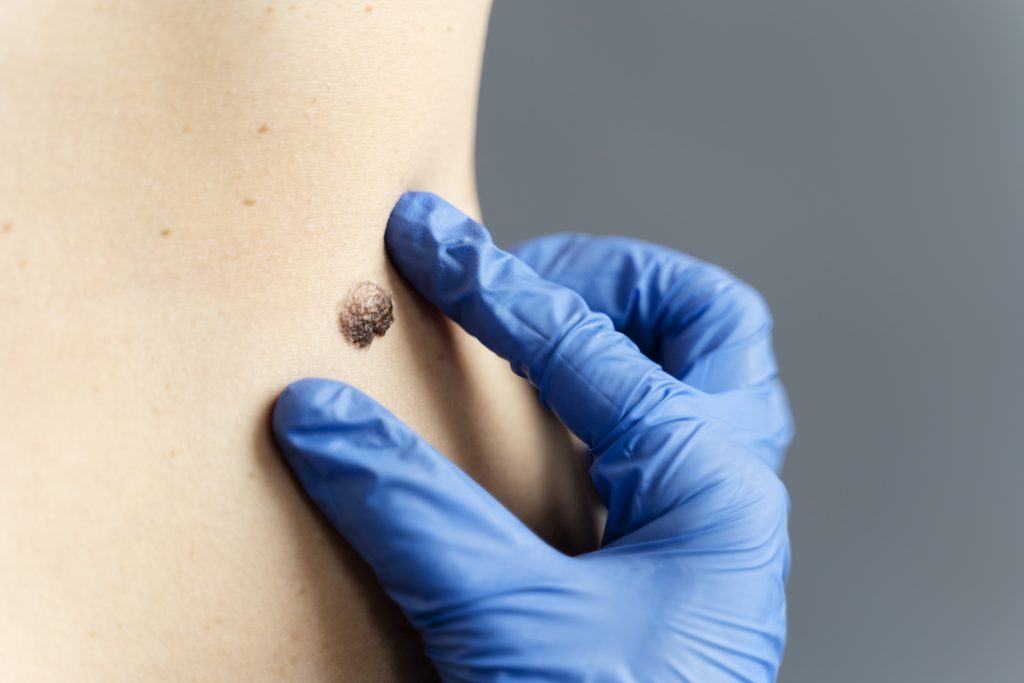 Mole Removal in Sharjah: Safe, Quick & Expert One-Day Procedure at Gaelan Hospital