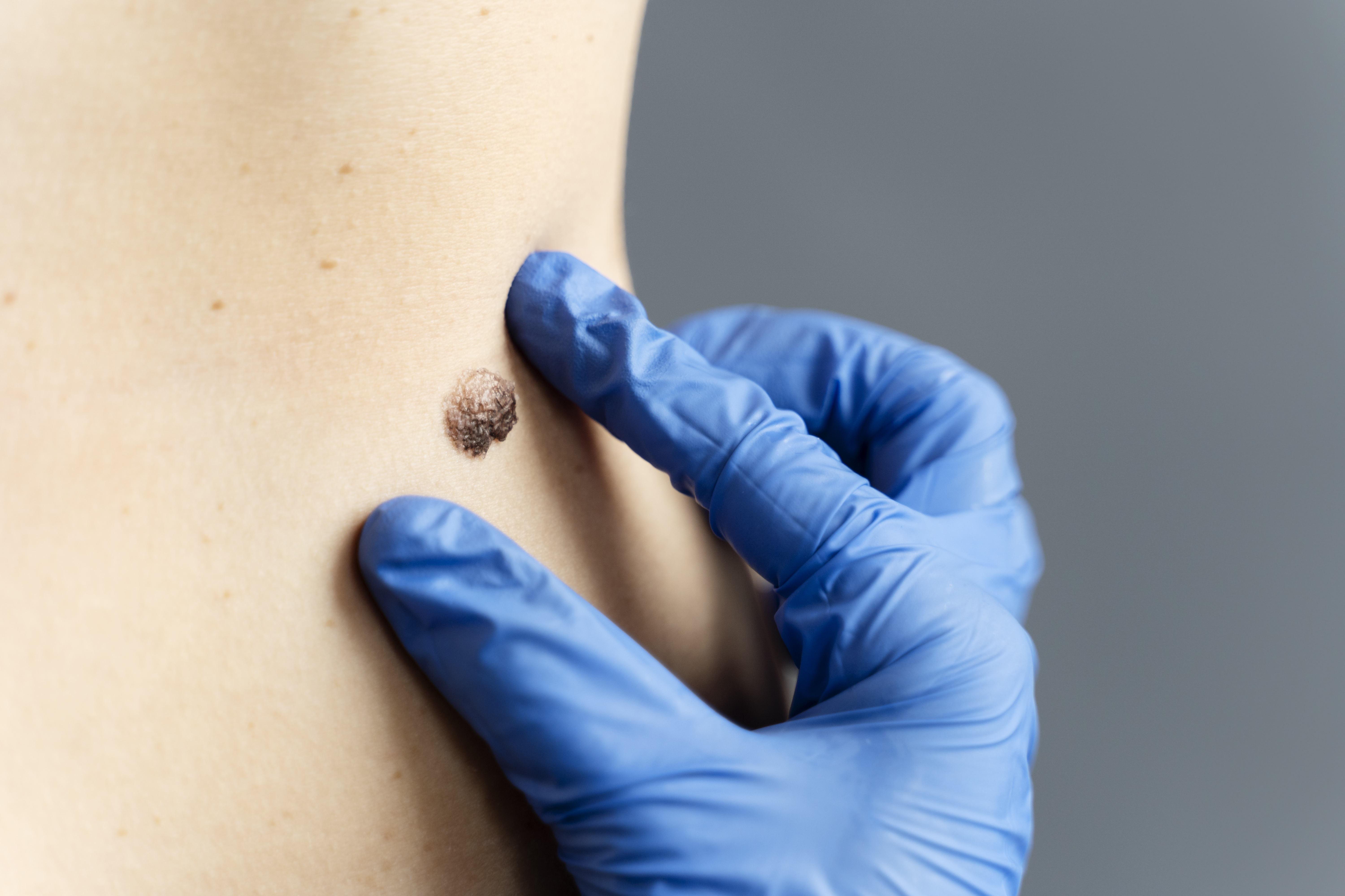 Mole Removal in Sharjah: Safe, Quick & Expert One-Day Procedure at Gaelan Hospital